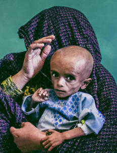 Forstår ikke hvorfor afghanske barn rammes av akutt underernæring
