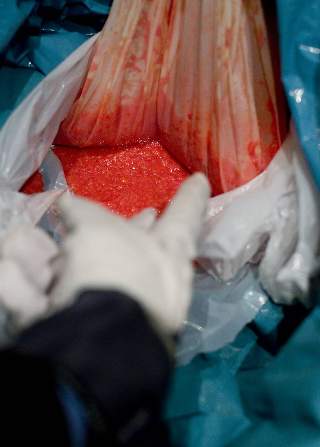 SAMMEN MED MATAVFALL: Denne posen med blod og fett etter en fettsuging, fant veien til s�ppelkassene i bakg�rden. Posen var umerket og denne typen innhold skal behandles som smittefarlig avfall, if�lge fylkeslegen i Oslo. Foto: Bj�rn Langsem/Dagbladet.no