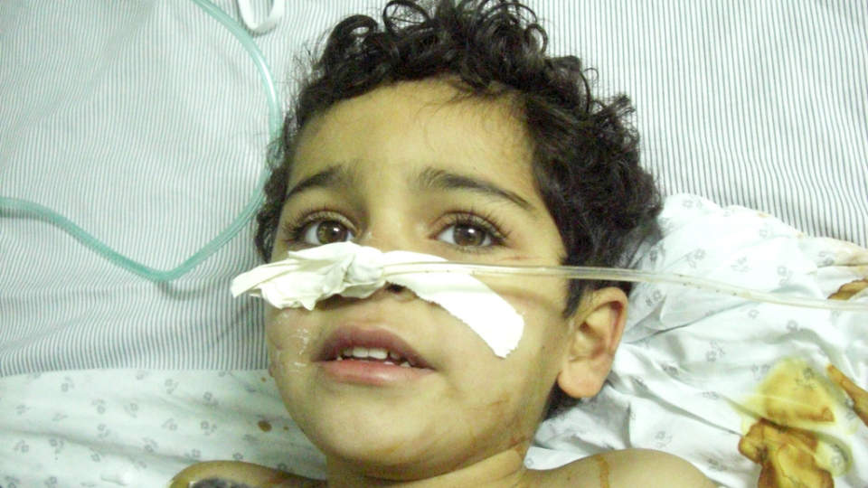 LAMMET: Salmah Abed Rabu (4) ble truffet av splinter etter at huset hun og familien bodde i ble truffet av en bombe.

Hun har en alvorlig skade i ryggen, og m�tte opereres samme kveld hun ble tatt inn til sykehuset. Hun er delvis lammet. Foto: NORWAC