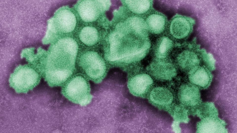 SMITTET OMKOM: Europas f�rste registrerte d�dsfall som f�lge H1N1-varianten popul�rt kalt svineinfluensa er meldt i Skottland. Foto: SCANPIX/AP Photo/Center for Disease Control and Prevention