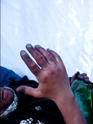 F�RSTE TITT P� SKADENE: I Advanced basekamp fikk Tr� sett skadene han p�dro seg i fjellsiden, forfrosne fingre og t�r. Faren for at han m� amputere er overhengende. Foto: www.everest09.no