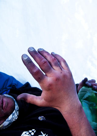 FINGRENE I FARE: I likhet med t�rne er Tr�s fingrer alvorlig frostskadet, og det er uklart om han m� amputere. Foto: EVEREST09.NO