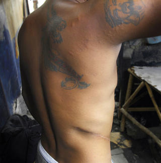 ILLEGALT ORGANSALG: Det er veldokumentert at levende, fattige donorer gir fra seg organer for penger. Bildet fra mars i fjor viser Mark Garcia, som fortalte at han hadde solgt en nyre i Manila. Foto: AFP/JES AZNAR