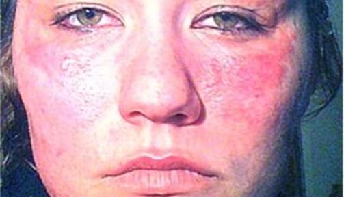 KRAFTIG REAKSJON: Slik s� Cathrine V. Svendsen (28) ut da hun tok av halloweensminken. Foto: Privat