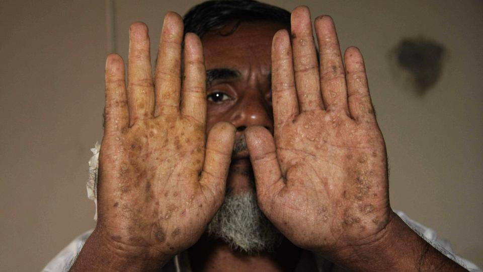  ARSENIKK-SKADER:  To millioner mennesker har f�tt helseskader av arsenikk i grunnvannet i Bangladesh. Bonden Abdul Haq er en av dem - her inne til helsesjekk p� et sykehus i hovedstaden Dhaka. Foto: JAHIDUL ALAN, AP/SCANPIX.