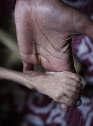 F�DT MED SKADER: Sv�rt mange barn i n�rheten av Union Carbide-fabrikken i Bhopal er f�dt med store skader. P� bildet holder en fysioterapeut foten til en sju �r gammel gutt. Foto: AP Photo/Saurabh Das