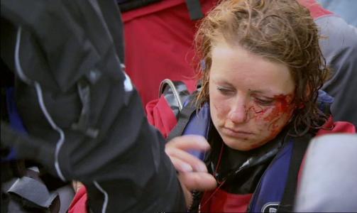 BLODIG MINNE FOR LIVET: Anniken Sand har f�tt et arr like under �yenbrynet etter slaget fra bommen. Foto: TVNORGE