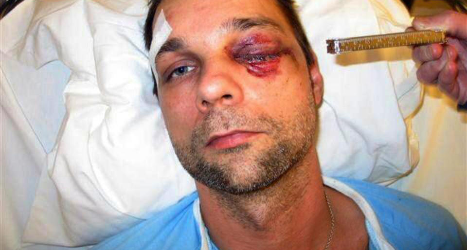 MISTET SYNET: Geir Fossum ble skadet av en rakett nytt�rsaften 2005-2006. Skadene f�rte til at han ble blind p� det ene �yet. 
Foto: POLITIET/SCANPIX