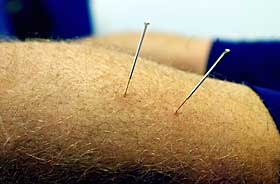  �KT ETTERSP�RSEL: Flere vil pr�ve akupunktur i forbindelse med smertelindring.