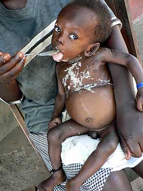FEILERN�RT: Christopher Oleke, et internt fordrevet flyktningebarn som er feilern�rt, f�r mat p� Adwari Corner-flyktningeleiren i Lira-distriktet i Uganda i juli i �r.