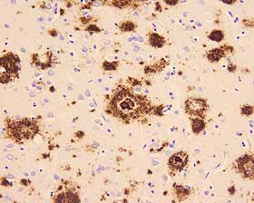BETA-AMYLOID: Forskerne tror hukommelsessvikten som Alzheimers medf�rer, skyldes overproduksjon av proteinet beta-amyloid. Disse �a(beta)-peptidene� klumper seg sammen og danner opphopninger i hjernen. Mengden slike peptider �ker proporsjonalt med graden av demens.