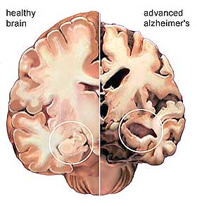 N�KKELOMR�DE: Forskningsteamet skal studere hvordan Alzheimers sykdom utvikler seg i hjernen. Hos pasientene minskes s�rlig hippocampus, omr�det i hjernebarken der minner og hukommelse dannes.