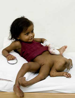 FIRE ARMER OG FIRE BEIN: Lakshmi Tatma gjennomgikk i november i fjor en f�rti timer lang operasjon, der tvillingkroppen ble fjernet. P� landsbygda mente mange at hun var reinkarnasjonen av guden Vishnu.