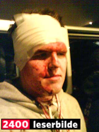 PLASTRET: Slik s� Kenneth Hansen ut etter � ha blitt truffet i hodet av en stein.