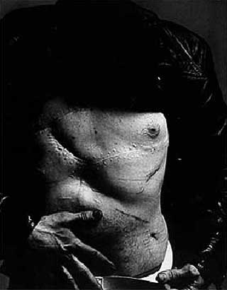 BLE SKUTT I MAGEN AV SOLANAS: Kunstneren Andy Warhol, New York, 20. august 1969. Han ble alvorlig skadet av skuddene, og slet med skadene resten av livet.